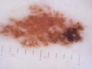 Melanoma