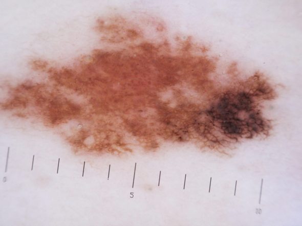 Melanoma